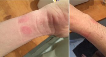 Apple Watch : des allergies sur les poignets de certains utilisateurs