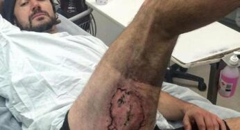 Un australien brûlé au troisième degré par son iPhone 6